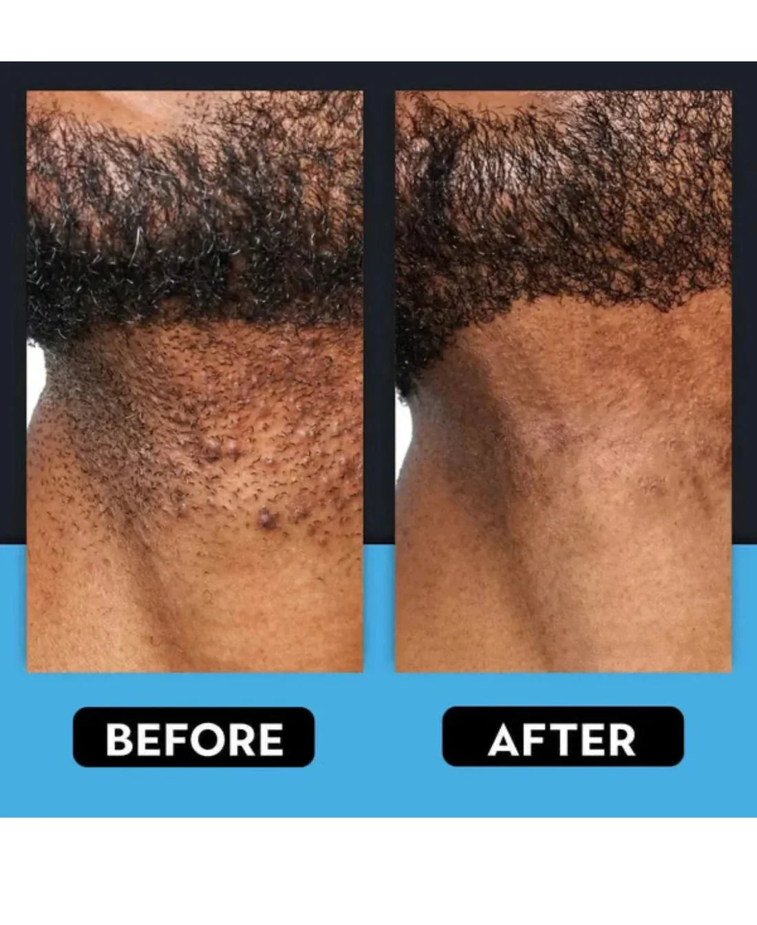 Ingrown Hair Treatment – Soothe, Clear & Prevent Razor Bumps – My Store
